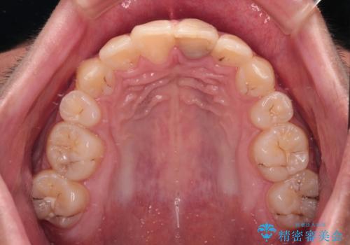 膨らんだ口元 ワイヤー装置での抜歯矯正の治療後