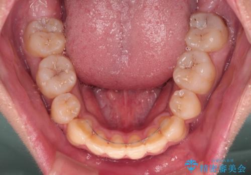 膨らんだ口元 ワイヤー装置での抜歯矯正の治療後