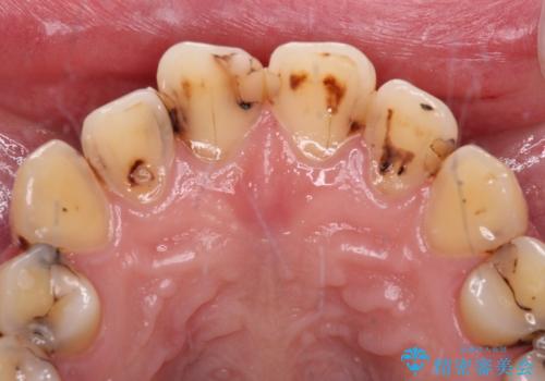 むし歯だらけの前歯をオールセラミッククラウンできれいにの治療前