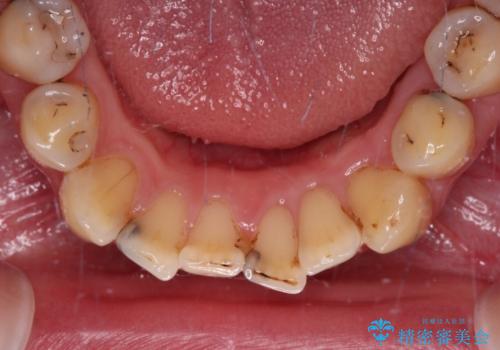 むし歯だらけの前歯をオールセラミッククラウンできれいにの治療前