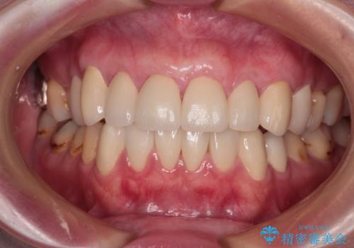 むし歯だらけの前歯をオールセラミッククラウンできれいにの治療後