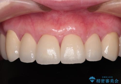 むし歯だらけの前歯をオールセラミッククラウンできれいにの治療後