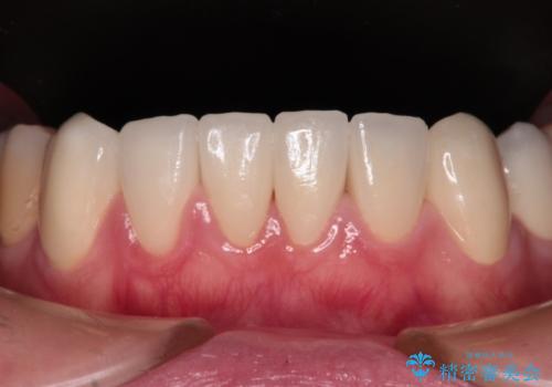 むし歯だらけの前歯をオールセラミッククラウンできれいにの治療後