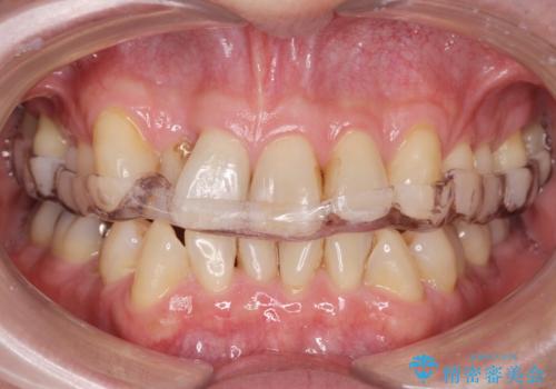 ナイトガードで歯の負担の予防の症例 治療後