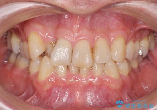 ナイトガードで歯の負担の予防の症例 治療前