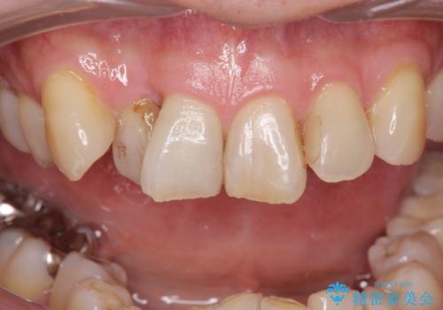 ナイトガードで歯の負担の予防の治療前