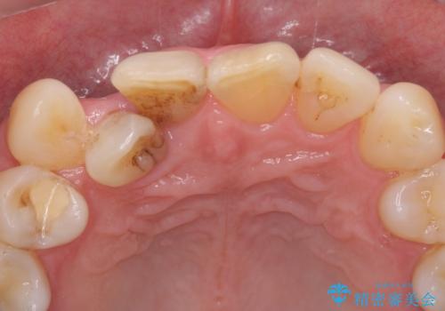 ナイトガードで歯の負担の予防の治療前