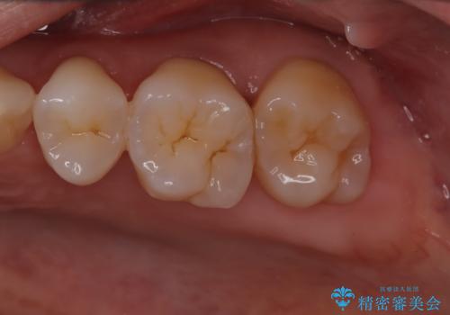 歯周病治療【オープンフラップ】の治療前
