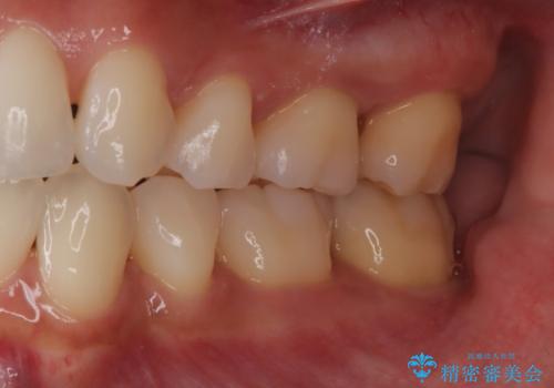 歯周病治療【オープンフラップ】の治療前