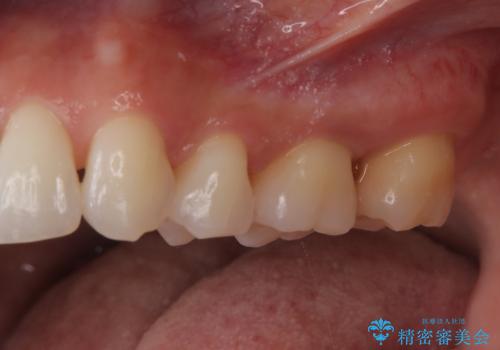 歯周病治療【オープンフラップ】の治療前