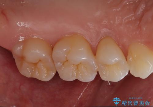 歯周病治療【オープンフラップ】の治療前