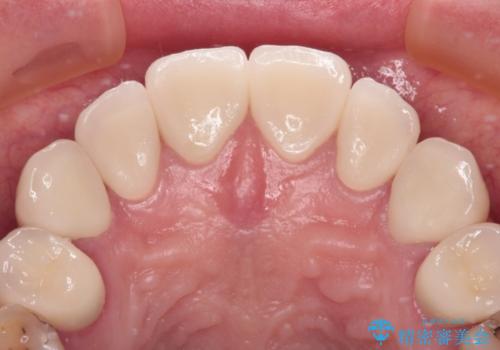 むし歯だらけの前歯をオールセラミッククラウンできれいにの治療後