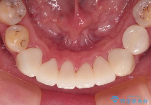 むし歯だらけの前歯をオールセラミッククラウンできれいにの治療後