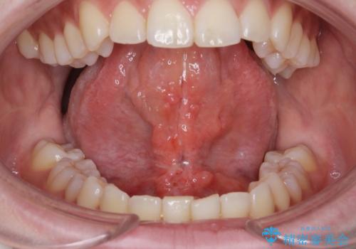 舌小帯切除の治療後