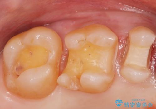 メタルインレーやりかえの治療中