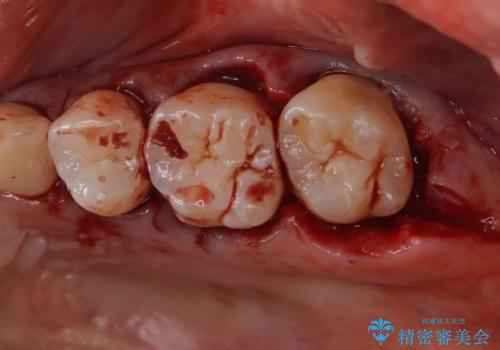 歯周病治療【オープンフラップ】の治療中