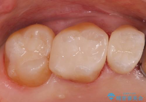 メタルインレーやりかえの症例 治療後