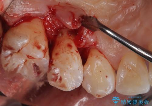 歯周病治療【オープンフラップ】の治療中