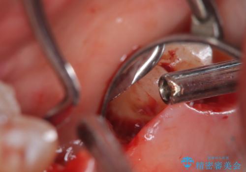歯周病治療【オープンフラップ】の治療中