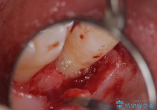 歯周病治療【オープンフラップ】の治療中