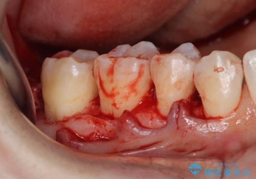 歯周病治療【オープンフラップ】の治療後
