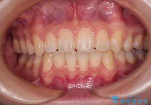 【モニター】口が閉じにくい 抜歯矯正で口元を引っ込めるの症例 治療後