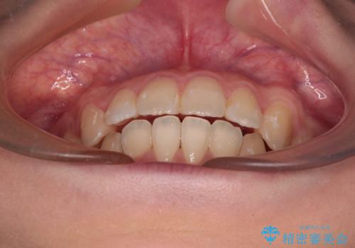 【モニター】口が閉じにくい 抜歯矯正で口元を引っ込めるの治療後