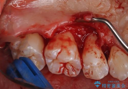 歯周病治療【オープンフラップ】の治療後