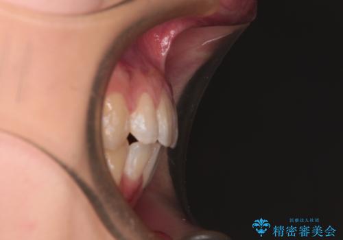 【モニター】口が閉じにくい 抜歯矯正で口元を引っ込めるの治療後