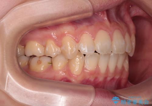 【モニター】口が閉じにくい　抜歯矯正で口元を引っ込めるの治療後