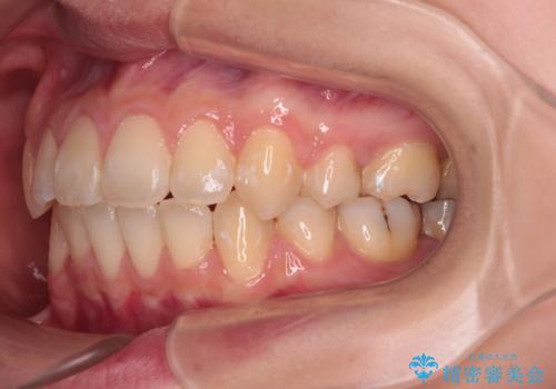 【モニター】口が閉じにくい 抜歯矯正で口元を引っ込めるの治療後