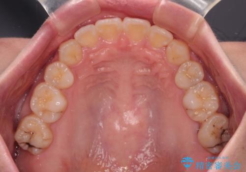 【モニター】口が閉じにくい 抜歯矯正で口元を引っ込めるの治療後