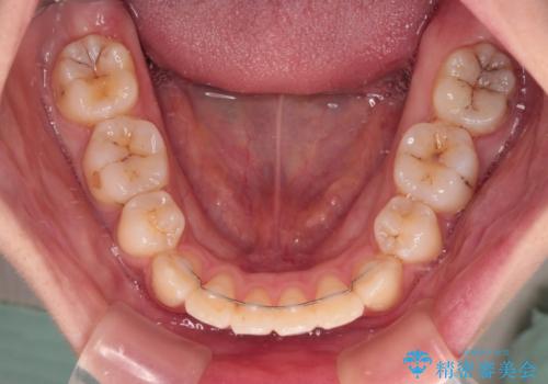 【モニター】口が閉じにくい 抜歯矯正で口元を引っ込めるの治療後