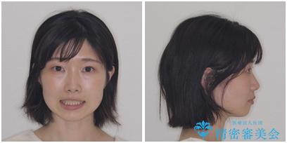 【モニター】口が閉じにくい 抜歯矯正で口元を引っ込めるの治療後(顔貌)