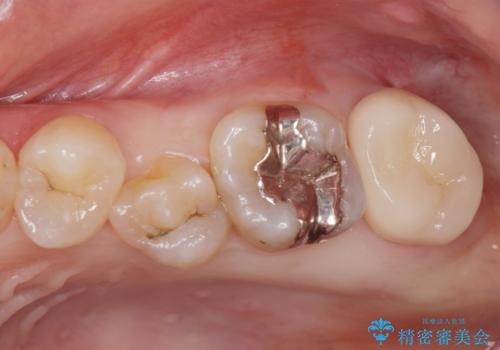 黒くなった奥歯をジルコニアクラウンにの症例 治療後