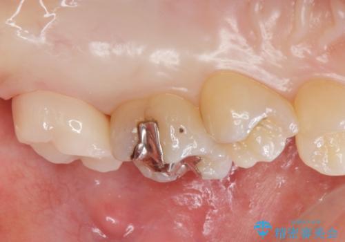 黒くなった奥歯をジルコニアクラウンにの治療後