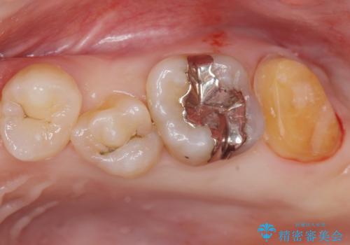 黒くなった奥歯をジルコニアクラウンにの治療中