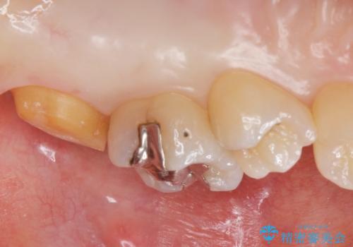 黒くなった奥歯をジルコニアクラウンにの治療中