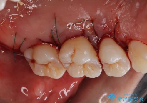 歯周病治療【オープンフラップ】の治療後