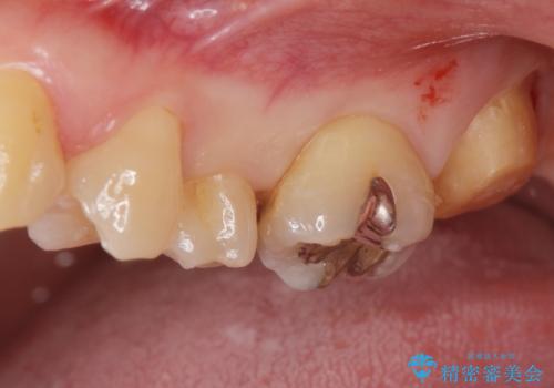 黒くなった奥歯をジルコニアクラウンにの治療中