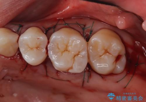 歯周病治療【オープンフラップ】の治療後