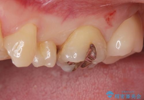黒くなった奥歯をジルコニアクラウンにの治療後