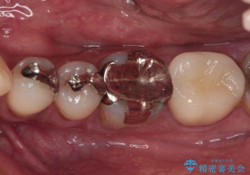 治療をしても違和感の続く奥歯 神経を極力残した虫歯治療の治療後