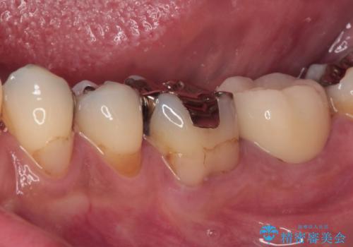 治療をしても違和感の続く奥歯　神経を極力残した虫歯治療の治療後