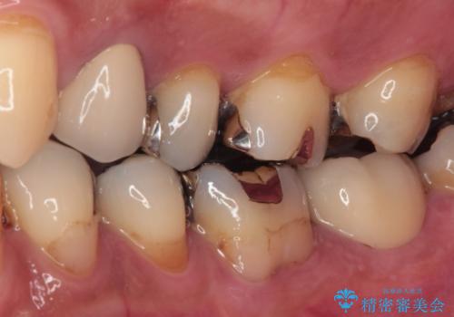 治療をしても違和感の続く奥歯 神経を極力残した虫歯治療の治療後