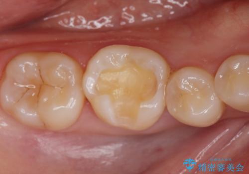 セラミックインレー治療の治療中