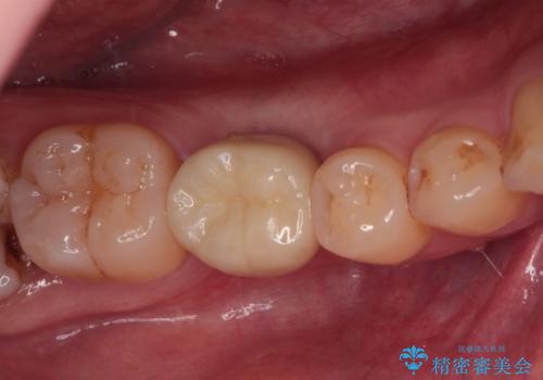 空いている時間を利用して通院 奥歯のインプラント治療の症例 治療後