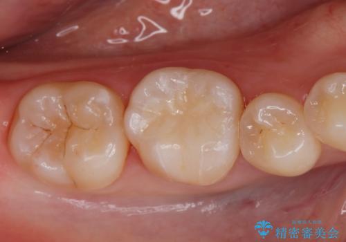 セラミックインレー治療の症例 治療後