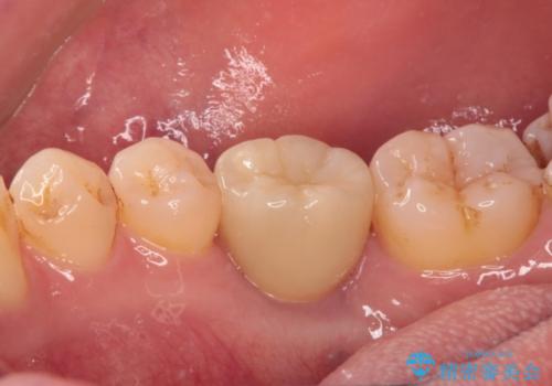 空いている時間を利用して通院 奥歯のインプラント治療の治療後