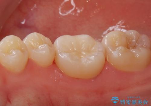 セラミックインレー治療の治療後